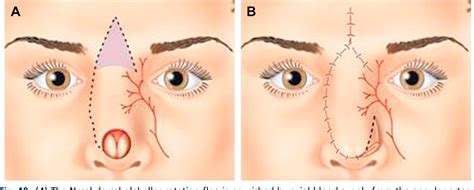 Figure 10 From Transposition Flaps In Nasal Reconstruction Semantic