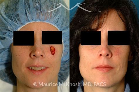 New York Facial Plastic Surgery Mohs Reconstruction Of Cheeks Before