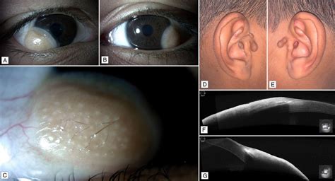 Isolated Bilateral Limbal Dermoid Preauricular Skin Tags And Ametropic
