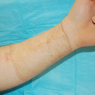 Outline Of The Radial Forearm Free Flap Phalloplasty On The Arm The Download Scientific