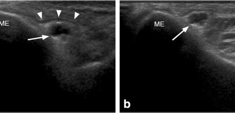 Ultrasound Measurements And Assessments Of The Ulnar Nerve At The Elbow