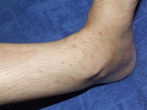 Flea Bites On Ankles