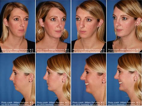 Rhinoplasty And Chin Implant Before And After Rhinoplasty Patients