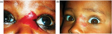 A The Capillary Hemangioma Of The Upper Nose Region B The