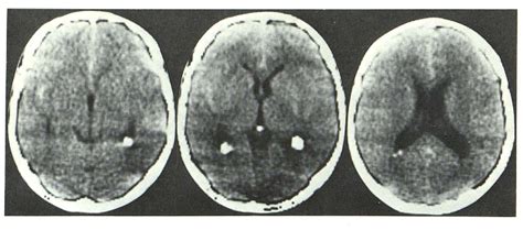 Figure 1 From Subarachnoid Hemorrhage Secondary To Ruptured