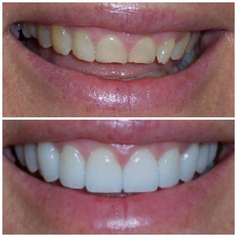 Before and after smile makeovers vogue dental studios – Artofit