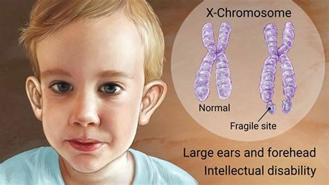 Fragile X Syndrome Brochure