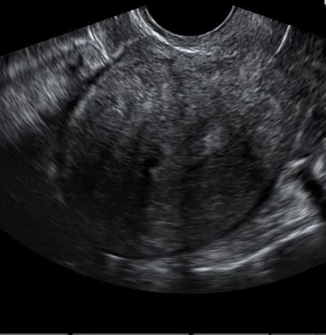 [34 ] Uterine Prolapse Ultrasound Radiopaedia