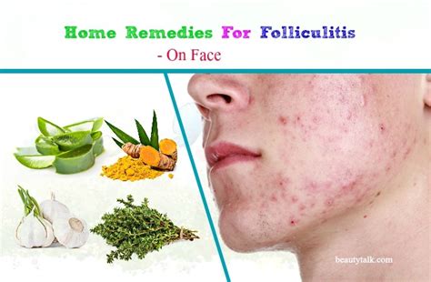 24 Most Effective Home Remedies For Folliculitis On Face And Scalp