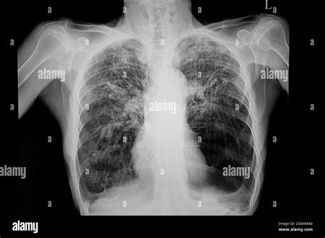 Radiografía De Tórax De Un Paciente Con Pulmones Enfisematosos