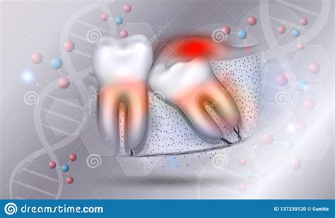 Wisdom Tooth And Inflamed Gums Stock Vector Illustration Of Care