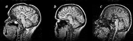 Agenesis Of The Corpus Callosum The Brain Clinic