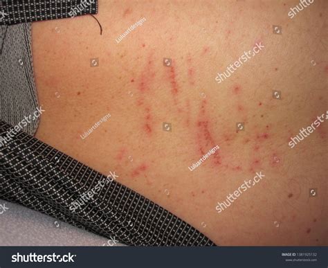 Back Scratches Red Scratches On Back Stock Photo 1381925132 Shutterstock