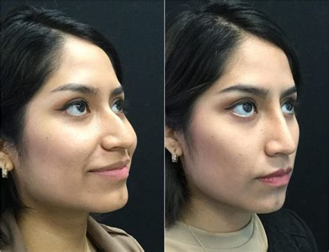I recently turned sixteen and have always been insecure about the bump it was very painless and a better option than getting my nose surgically done. Non-Surgical Rhinoplasty | Before And After Photos | Fairfax