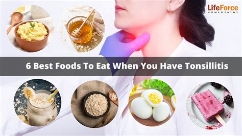 Best Foods To Eat When You Have Tonsillitis