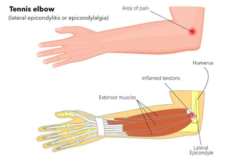 Pitcures Of The Tendons In Tbe Forearm Extensor Tendon Injury In The
