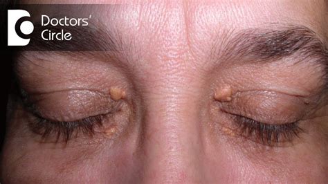 How To Get Rid Of Skin Tags From Upper Eyelids Or Eye Region Dr