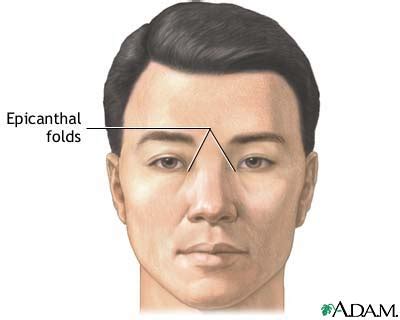 Fetal alcohol syndrome epicanthal folds flat nasal bridge small palpebral fissures upturned nose. Common Syndromes | Am-Medicine