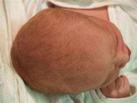 Head Newborn Nursery Stanford Medicine
