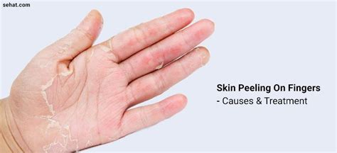 Skin Peeling On Fingers Near Nails Between Fingers Palms Of Hands