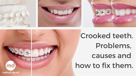 Dental bonding or porcelain veneers offer the fastest result in correcting crooked teeth. Title Image Crooked Teeth Blog Method Dental - Method Dental