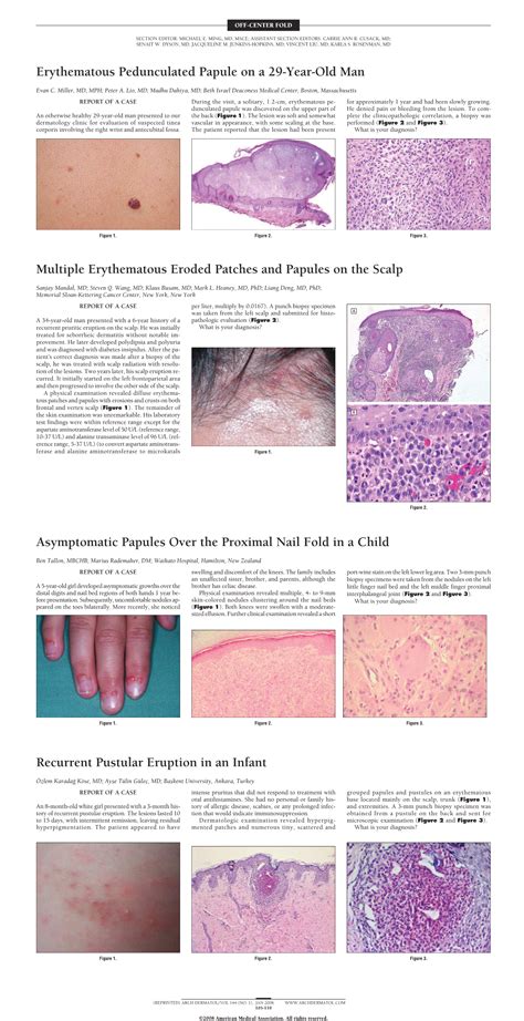Erythematous Pedunculated Papule On A 29 Year Old Man—quiz Case