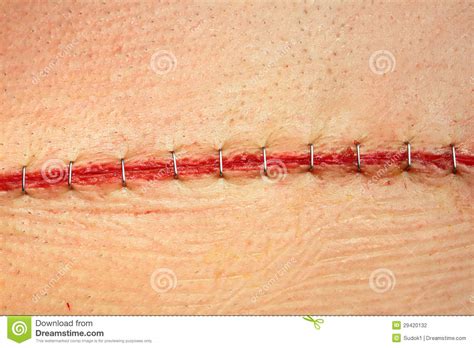 Modern Surgical Suture Stock Photo Image Of Close Group 29420132