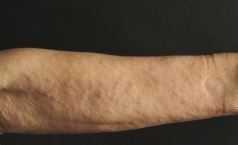 Keratosis Pilaris Reibeisenhaut Online Diagnose And Hilfe Von Hautärzten