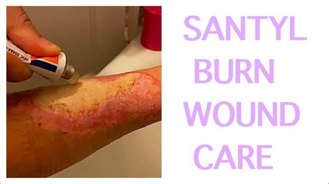 Nd Rd Degree Burns Wound Care With Santyl Youtube
