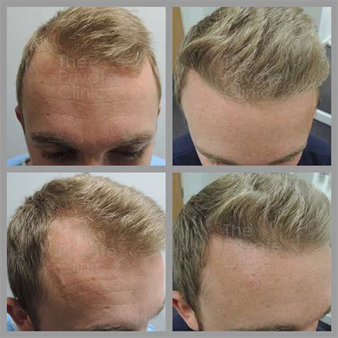 Update Hair Transplant Before After Best Poppy
