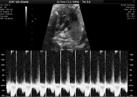 Prenatal Sonographic Diagnosis Of Premature Constriction Of The Fetal