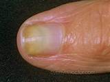 Fingernail Eczema Treatment Pictures