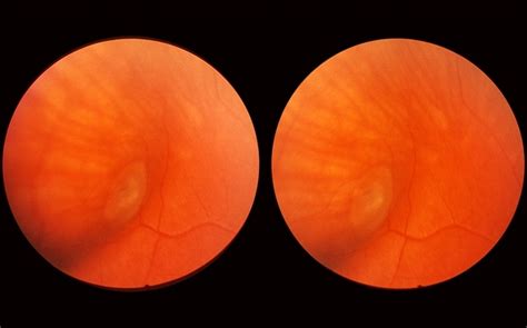 Scleral Indentation Retina Image Bank