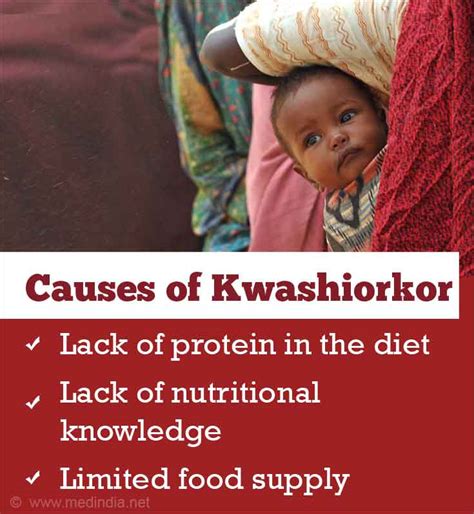 Protein Deficiency Kwashiorkor