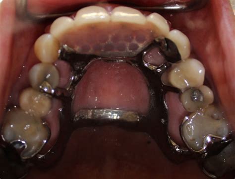 3 Case 1 Metal Upper Partial Denture In Mouth