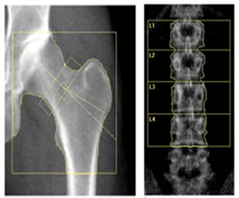 Bone Density Scan Results Bone Densitometry The More Bone Material