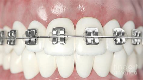 Dental Braces Photograph By Sebastian Kaulitzki Science Photo Library Fine Art America