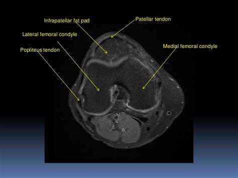 Helps to lower and raise the body. MRI KNEE JOINT ANATOMY
