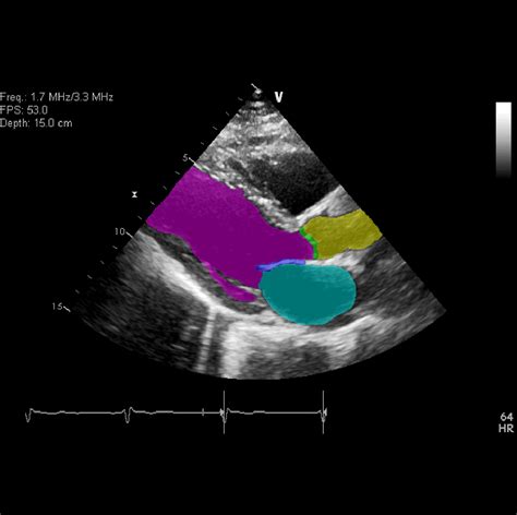 Deep Learning For Cardiac Ultrasound Echocardiography