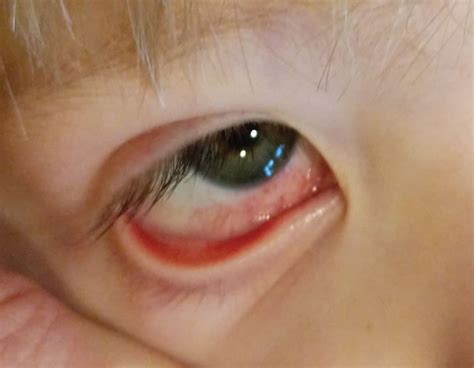Vaccines And Vulnerable Eyes What To Look For