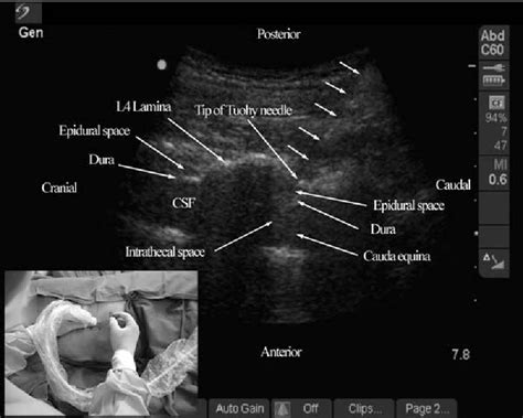 Figure 3 From Real Time Ultrasound Guided Paramedian Epidural Access