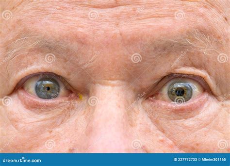 Senior Man With Anisocoria Showing Unequal Dilation Of His Pupil Stock