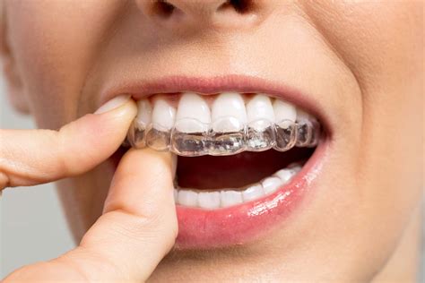 Teeth Braces Types Adults