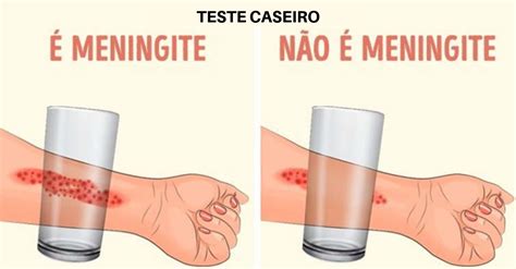 Teste Caseiro Para Caxumba