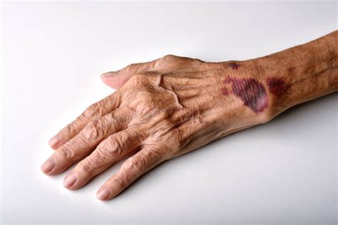 Broken Blood Vessel Stock Photos Pictures And Royalty Free Images Istock