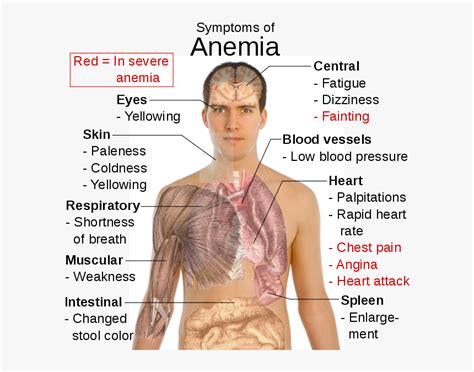 Symptoms Of Anaemia Symptoms Of Anemia Hd Png Download Kindpng