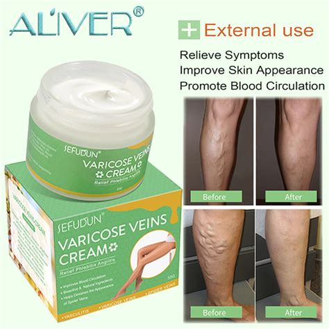 Aliver Varicose Veins Treatment Cream Ointment Vasculitis Phlebitis