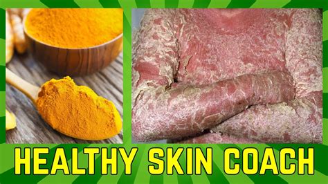 Tumeric Is The Miracle Cure For Psoriasis Youtube