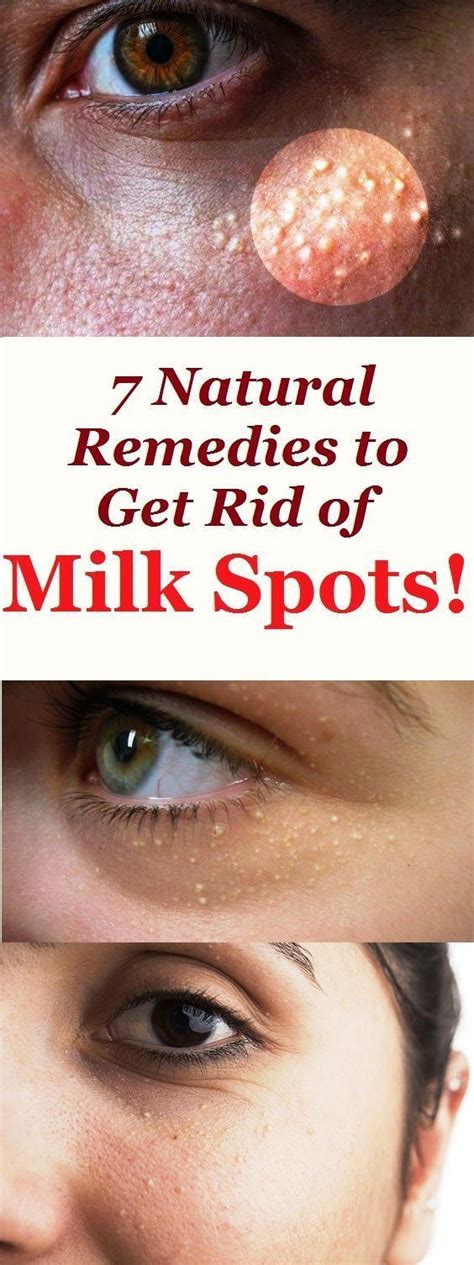 7 Natural Remedies To Get Rid Of Milk Spots Milk Spots Skin Natural