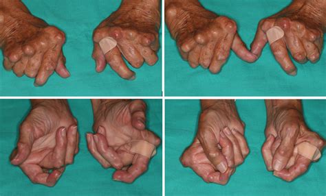 Artritis Reumatoide En Mano Cirugía E Inserción De Prótesis
